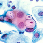 Chlamydia